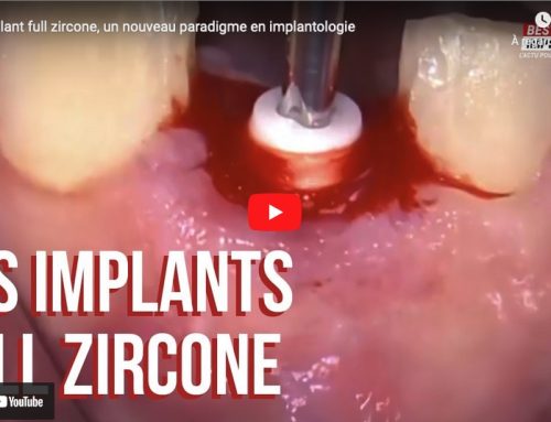 Les implants full-zircone en micro-chirurgie : les révélations du Dr Fabrice Baudot